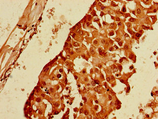 PPP1R13B Antibody - Immunohistochemistry of paraffin-embedded human breast cancer using PPP1R13B Antibody at dilution of 1:100