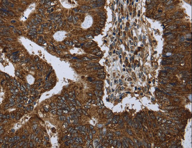 PPP1R13L / iASPP Antibody - Immunohistochemistry of paraffin-embedded Human colon cancer using PPP1R13L Polyclonal Antibody at dilution of 1:30.