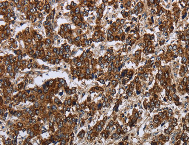 PPP1R13L / iASPP Antibody - Immunohistochemistry of paraffin-embedded Human liver cancer using PPP1R13L Polyclonal Antibody at dilution of 1:30.