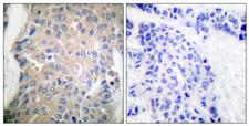 PPP1R14A / CPI-17 Antibody - Immunohistochemistry analysis of paraffin-embedded human breast carcinoma tissue, using CPI17 alpha Antibody. The picture on the right is blocked with the synthesized peptide.