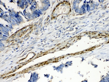 PPP1R14A / CPI-17 Antibody - IHC testing of FFPE human intestinal cancer tissue with CPI-17 antibody at 1ug/ml. Required HIER: steam section in pH6 citrate buffer for 20 min and allow to cool prior to testing.