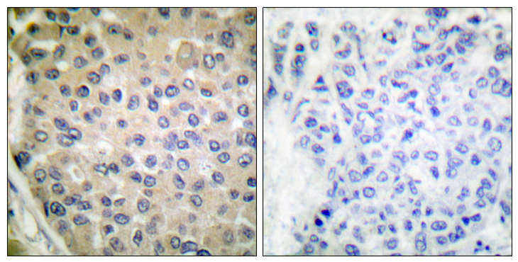 PPP1R14A / CPI-17 Antibody - Immunohistochemistry analysis of paraffin-embedded human breast carcinoma, using CPI17 alpha (Phospho-Thr38) Antibody. The picture on the right is blocked with the phospho peptide.