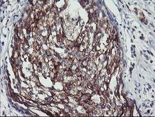 PPP1R15A / GADD34 Antibody - IHC of paraffin-embedded Adenocarcinoma of Human breast tissue using anti-PPP1R15A mouse monoclonal antibody.