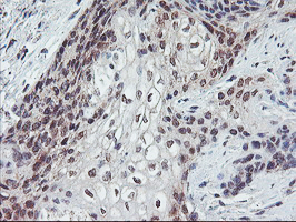 PPP1R15A / GADD34 Antibody - IHC of paraffin-embedded Carcinoma of Human bladder tissue using anti-PPP1R15A mouse monoclonal antibody.
