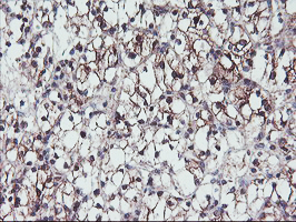 PPP1R15A / GADD34 Antibody - IHC of paraffin-embedded Carcinoma of Human kidney tissue using anti-PPP1R15A mouse monoclonal antibody.