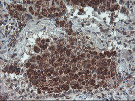 PPP1R15A / GADD34 Antibody - IHC of paraffin-embedded Carcinoma of Human lung tissue using anti-PPP1R15A mouse monoclonal antibody.