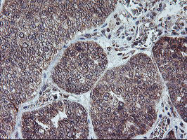 PPP1R15A / GADD34 Antibody - IHC of paraffin-embedded Adenocarcinoma of Human ovary tissue using anti-PPP1R15A mouse monoclonal antibody.