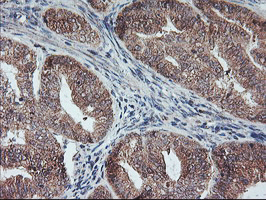 PPP1R15A / GADD34 Antibody - IHC of paraffin-embedded Adenocarcinoma of Human endometrium tissue using anti-PPP1R15A mouse monoclonal antibody.