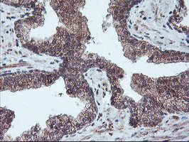 PPP1R15A / GADD34 Antibody - IHC of paraffin-embedded Carcinoma of Human prostate tissue using anti-PPP1R15A mouse monoclonal antibody.