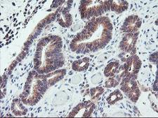 PPP1R15A / GADD34 Antibody - IHC of paraffin-embedded Adenocarcinoma of Human colon tissue using anti-PPP1R15A mouse monoclonal antibody.