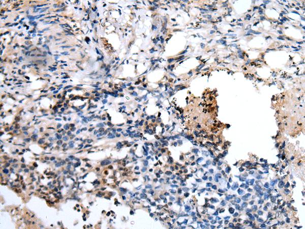 PPP1R15A / GADD34 Antibody - Immunohistochemistry of paraffin-embedded Human lung cancer tissue  using PPP1R15A Polyclonal Antibody at dilution of 1:45(×200)