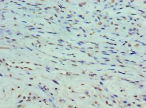 PPP1R1B / DARPP-32 Antibody - Immunohistochemistry of paraffin-embedded human breast cancer using antibody at 1:100 dilution.