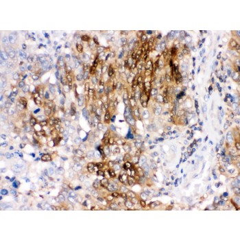 PPP1R1B / DARPP-32 Antibody - DARPP32 was detected in paraffin-embedded sections of human lung cancer tissues using rabbit anti- DARPP32 Antigen Affinity purified polyclonal antibody at 1 ug/mL. The immunohistochemical section was developed using SABC method.
