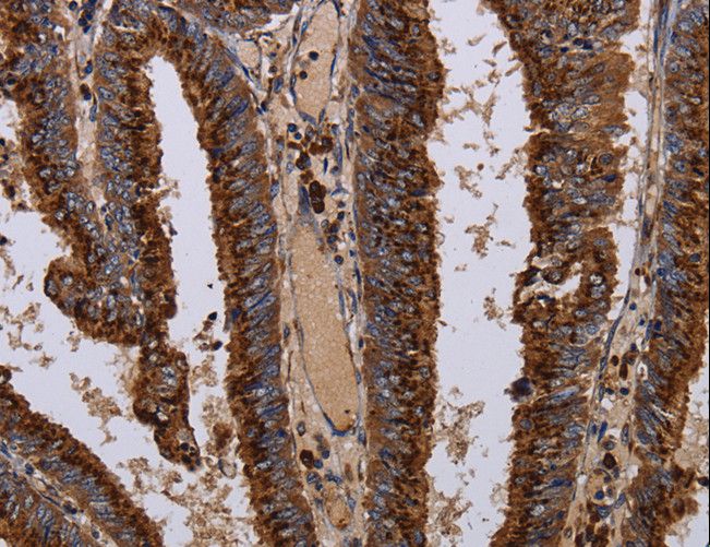 PPP1R1B / DARPP-32 Antibody - Immunohistochemistry of paraffin-embedded Human colon cancer using PPP1R1B Polyclonal Antibody at dilution of 1:50.