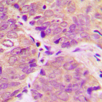 PPP1R1B / DARPP-32 Antibody - Immunohistochemical analysis of DARPP32 (pT34) staining in human breast cancer formalin fixed paraffin embedded tissue section. The section was pre-treated using heat mediated antigen retrieval with sodium citrate buffer (pH 6.0). The section was then incubated with the antibody at room temperature and detected using an HRP conjugated compact polymer system. DAB was used as the chromogen. The section was then counterstained with hematoxylin and mounted with DPX.
