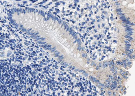 PPP1R1B / DARPP-32 Antibody - 1:100 staining human colon carcinoma tissue by IHC-P. The tissue was formaldehyde fixed and a heat mediated antigen retrieval step in citrate buffer was performed. The tissue was then blocked and incubated with the antibody for 1.5 hours at 22°C. An HRP conjugated goat anti-rabbit antibody was used as the secondary.