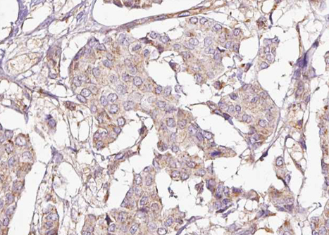 PPP1R1B / DARPP-32 Antibody - 1:100 staining human breast carcinoma tissue by IHC-P. The tissue was formaldehyde fixed and a heat mediated antigen retrieval step in citrate buffer was performed. The tissue was then blocked and incubated with the antibody for 1.5 hours at 22°C. An HRP conjugated goat anti-rabbit antibody was used as the secondary.