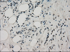 PPP1R7 Antibody - Immunohistochemical staining of paraffin-embedded Carcinoma of pancreas tissue using anti-PPP1R7 mouse monoclonal antibody. (Dilution 1:50).