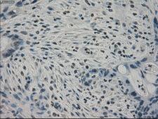 PPP1R7 Antibody - Immunohistochemical staining of paraffin-embedded Adenocarcinoma of colon tissue using anti-PPP1R7 mouse monoclonal antibody. (Dilution 1:50).