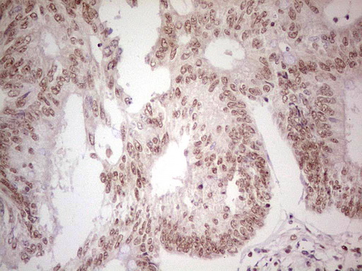 PPP1R8 / Rnase E Antibody - Immunohistochemical staining of paraffin-embedded Adenocarcinoma of Human colon tissue using anti-PPP1R8 mouse monoclonal antibody. (Heat-induced epitope retrieval by 1 mM EDTA in 10mM Tris, pH8.5, 120C for 3min,