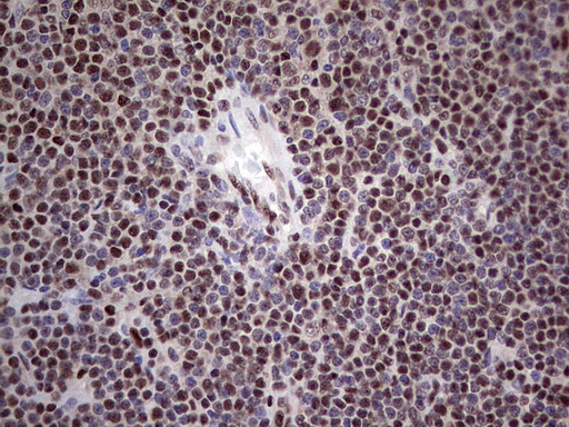 PPP1R8 / Rnase E Antibody - Immunohistochemical staining of paraffin-embedded Human lymphoma tissue using anti-PPP1R8 mouse monoclonal antibody. (Heat-induced epitope retrieval by 1 mM EDTA in 10mM Tris, pH8.5, 120C for 3min,