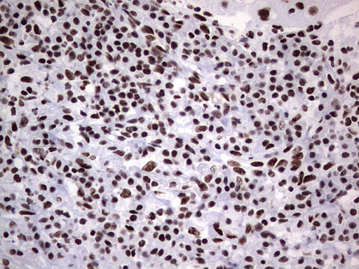 PPP1R8 / Rnase E Antibody - Immunohistochemical staining of paraffin-embedded Carcinoma of Human lung tissue using anti-PPP1R8 mouse monoclonal antibody. (Heat-induced epitope retrieval by 1 mM EDTA in 10mM Tris, pH8.5, 120C for 3min,