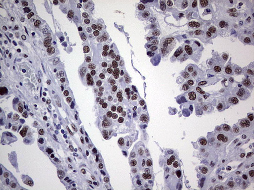 PPP1R8 / Rnase E Antibody - Immunohistochemical staining of paraffin-embedded Adenocarcinoma of Human ovary tissue using anti-PPP1R8 mouse monoclonal antibody. (Heat-induced epitope retrieval by 1 mM EDTA in 10mM Tris, pH8.5, 120C for 3min,