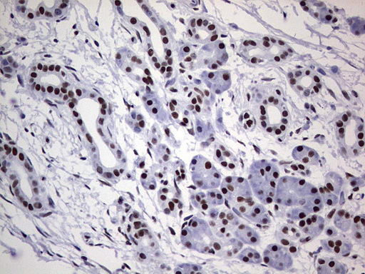 PPP1R8 / Rnase E Antibody - Immunohistochemical staining of paraffin-embedded Carcinoma of Human pancreas tissue using anti-PPP1R8 mouse monoclonal antibody. (Heat-induced epitope retrieval by 1 mM EDTA in 10mM Tris, pH8.5, 120C for 3min,