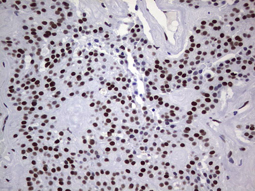 PPP1R8 / Rnase E Antibody - Immunohistochemical staining of paraffin-embedded Carcinoma of Human thyroid tissue using anti-PPP1R8 mouse monoclonal antibody. (Heat-induced epitope retrieval by 1 mM EDTA in 10mM Tris, pH8.5, 120C for 3min,