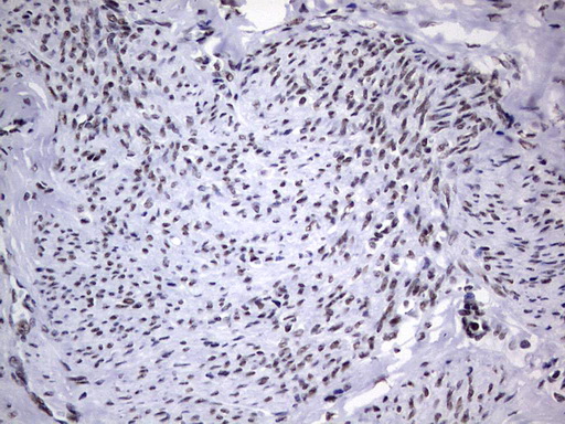PPP1R8 / Rnase E Antibody - Immunohistochemical staining of paraffin-embedded Adenocarcinoma of Human endometrium tissue using anti-PPP1R8 mouse monoclonal antibody. (Heat-induced epitope retrieval by 1 mM EDTA in 10mM Tris, pH8.5, 120C for 3min,