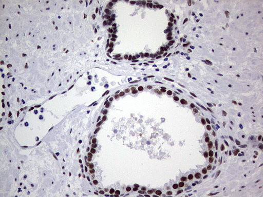 PPP1R8 / Rnase E Antibody - Immunohistochemical staining of paraffin-embedded Carcinoma of Human prostate tissue using anti-PPP1R8 mouse monoclonal antibody. (Heat-induced epitope retrieval by 1 mM EDTA in 10mM Tris, pH8.5, 120C for 3min,
