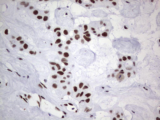 PPP1R8 / Rnase E Antibody - Immunohistochemical staining of paraffin-embedded Carcinoma of Human liver tissue using anti-PPP1R8 mouse monoclonal antibody. (Heat-induced epitope retrieval by 1 mM EDTA in 10mM Tris, pH8.5, 120C for 3min,