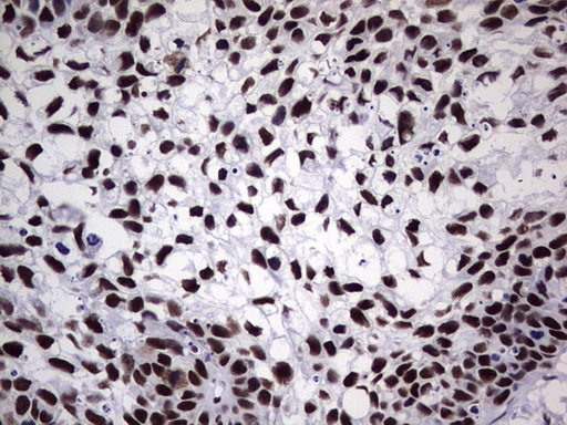 PPP1R8 / Rnase E Antibody - IHC of paraffin-embedded Carcinoma of Human kidney tissue using anti-PPP1R8 mouse monoclonal antibody. (Heat-induced epitope retrieval by 1 mM EDTA in 10mM Tris, pH8.5, 120°C for 3min).