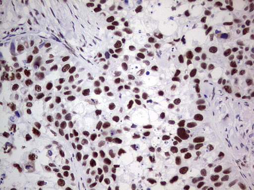 PPP1R8 / Rnase E Antibody - Immunohistochemical staining of paraffin-embedded Carcinoma of Human kidney tissue using anti-PPP1R8 mouse monoclonal antibody. (Heat-induced epitope retrieval by 1 mM EDTA in 10mM Tris, pH8.5, 120C for 3min,