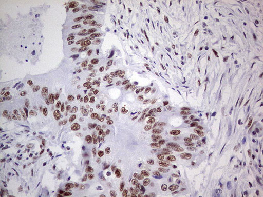 PPP1R8 / Rnase E Antibody - IHC of paraffin-embedded Adenocarcinoma of Human colon tissue using anti-PPP1R8 mouse monoclonal antibody. (Heat-induced epitope retrieval by 1 mM EDTA in 10mM Tris, pH8.5, 120°C for 3min).
