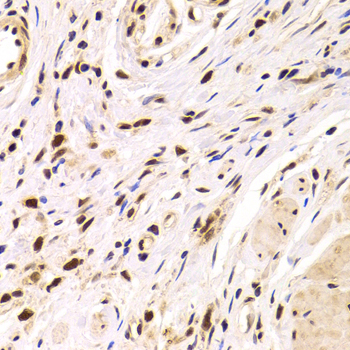 PPP1R8 / Rnase E Antibody - Immunohistochemistry of paraffin-embedded Human gastric cancer tissue.