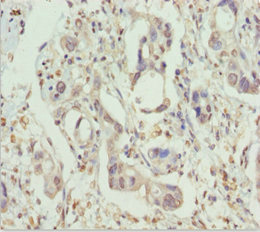 PPP1R8 / Rnase E Antibody - Immunohistochemistry of paraffin-embedded human pancreatic cancer at dilution 1:100