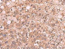 PPP2R1A Antibody - Immunohistochemistry of paraffin-embedded Human liver cancer tissue  using PPP2R1A Polyclonal Antibody at dilution of 1:65(×200)