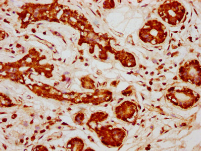PPP2R1B Antibody - IHC image of PPP2R1B Antibody diluted at 1:333 and staining in paraffin-embedded human breast cancer performed on a Leica BondTM system. After dewaxing and hydration, antigen retrieval was mediated by high pressure in a citrate buffer (pH 6.0). Section was blocked with 10% normal goat serum 30min at RT. Then primary antibody (1% BSA) was incubated at 4°C overnight. The primary is detected by a biotinylated secondary antibody and visualized using an HRP conjugated SP system.