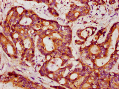 PPP2R1B Antibody - IHC image of PPP2R1B Antibody diluted at 1:403 and staining in paraffin-embedded human colon cancer performed on a Leica BondTM system. After dewaxing and hydration, antigen retrieval was mediated by high pressure in a citrate buffer (pH 6.0). Section was blocked with 10% normal goat serum 30min at RT. Then primary antibody (1% BSA) was incubated at 4°C overnight. The primary is detected by a biotinylated secondary antibody and visualized using an HRP conjugated SP system.