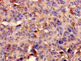 PPP2R2A Antibody - Immunohistochemistry of paraffin-embedded human melanoma cancer at dilution of 1:100