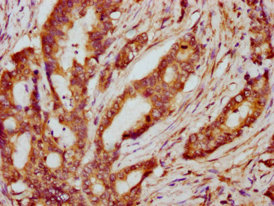 PPP2R2B Antibody - IHC image of PPP2R2B Antibody diluted at 1:600 and staining in paraffin-embedded human colon cancer performed on a Leica BondTM system. After dewaxing and hydration, antigen retrieval was mediated by high pressure in a citrate buffer (pH 6.0). Section was blocked with 10% normal goat serum 30min at RT. Then primary antibody (1% BSA) was incubated at 4°C overnight. The primary is detected by a biotinylated secondary antibody and visualized using an HRP conjugated SP system.