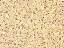 PPP2R2D Antibody - Immunohistochemistry of paraffin-embedded human glioma cancer at dilution of 1:100