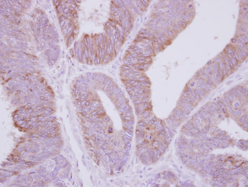 PPP2R3A / PR130 Antibody - IHC of paraffin-embedded Colon ca, using PPP2R3A antibody at 1:250 dilution.