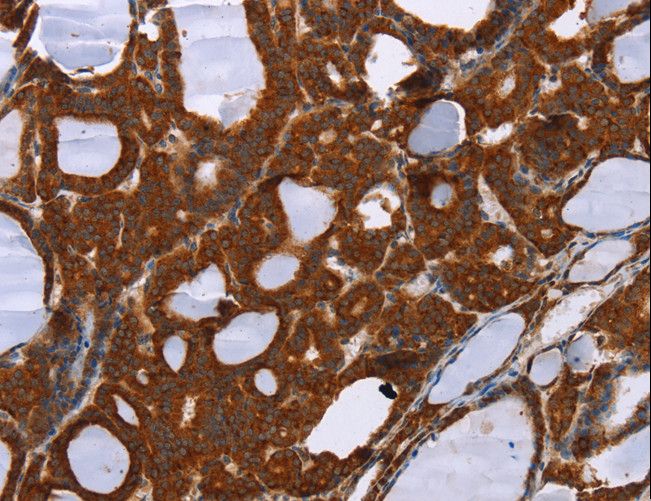 PPP2R3C Antibody - Immunohistochemistry of paraffin-embedded Human liver cancer using PPP2R3C Polyclonal Antibody at dilution of 1:30.