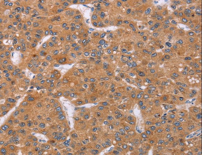 PPP2R3C Antibody - Immunohistochemistry of paraffin-embedded Human liver cancer using PPP2R3C Polyclonal Antibody at dilution of 1:30.