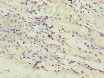 PPP2R3C Antibody - Immunohistochemistry of paraffin-embedded human gastric cancer at dilution of 1:100
