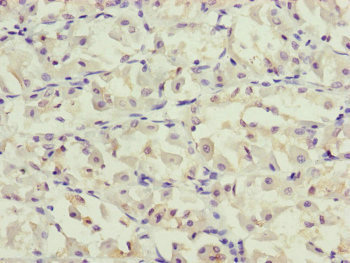 PPP2R3C Antibody - Immunohistochemistry of paraffin-embedded human gastric cancer at dilution of 1:100