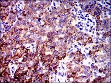 PPP2R4 Antibody - IHC of paraffin-embedded cervical cancer tissues using PPP2R4 mouse monoclonal antibody with DAB staining.