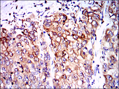 PPP2R4 Antibody - IHC of paraffin-embedded lung cancer tissues using PPP2R4 mouse monoclonal antibody with DAB staining.